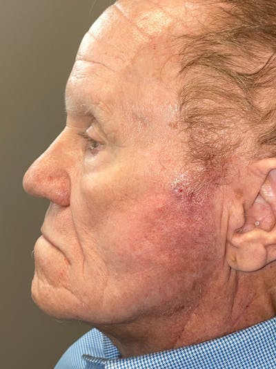 Threads Before & After Gallery - Patient 142942440 - Image 1