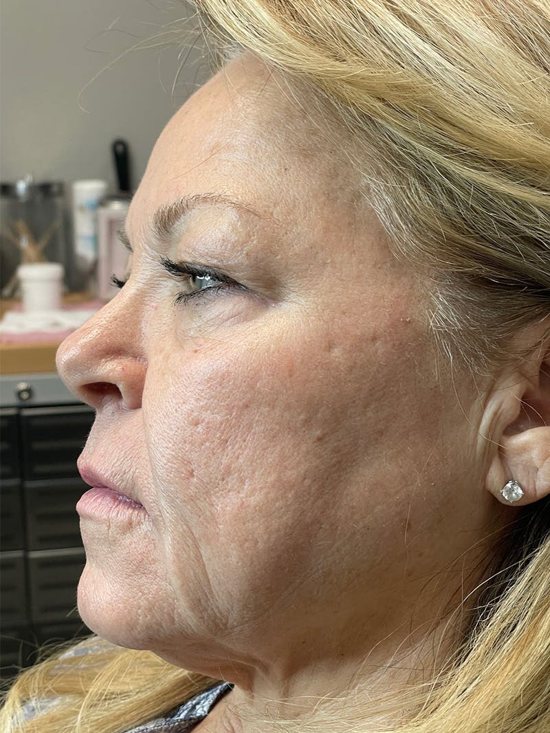 Threads Before & After Gallery - Patient 142942439 - Image 1