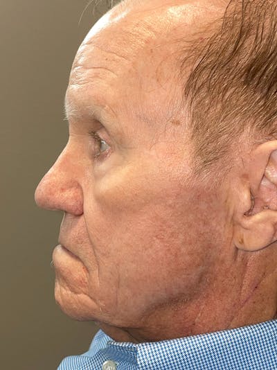 Threads Before & After Gallery - Patient 142942440 - Image 2