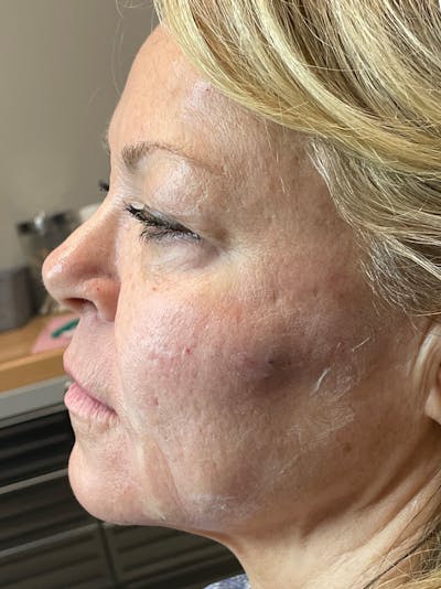 Threads Before & After Gallery - Patient 142942439 - Image 2