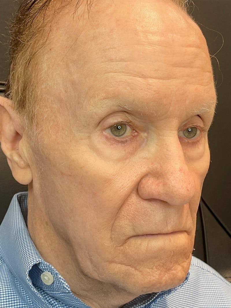 Threads Before & After Gallery - Patient 142942440 - Image 3