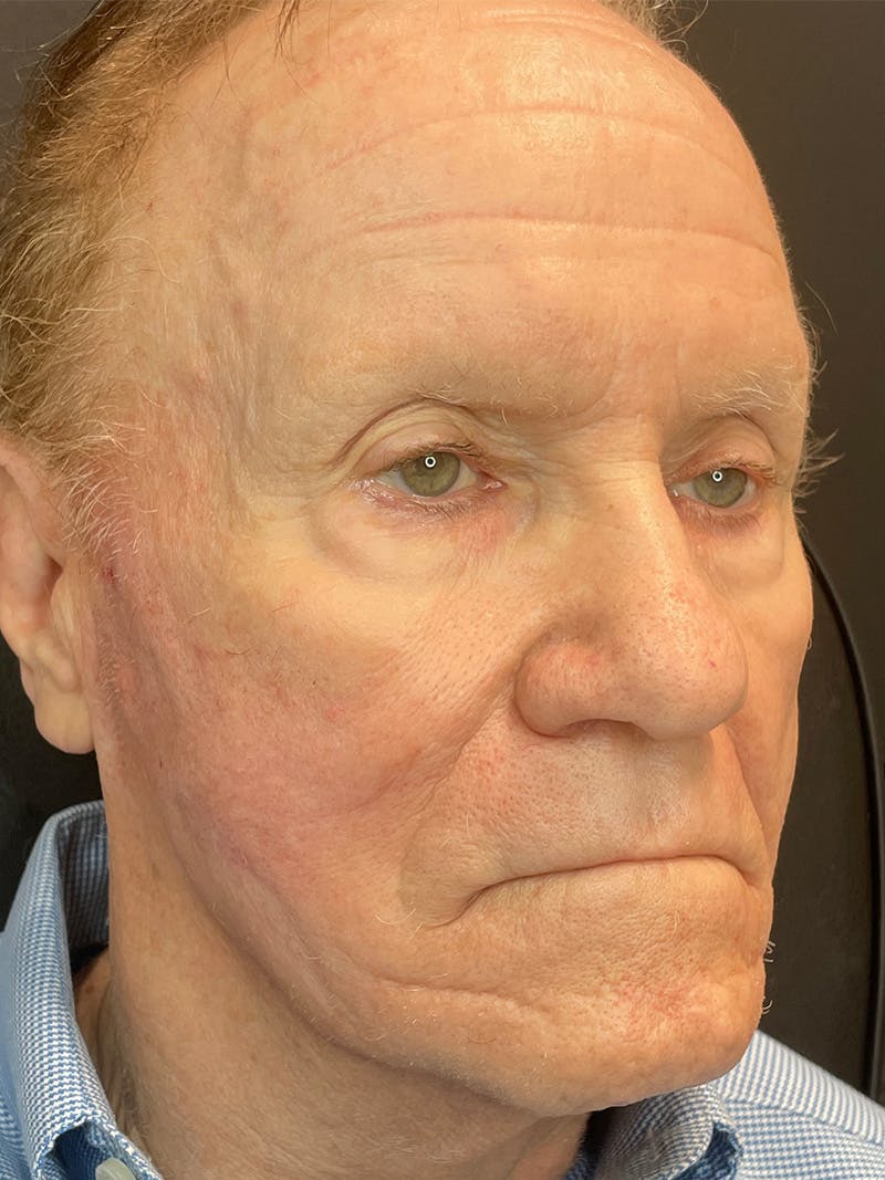 Threads Before & After Gallery - Patient 142942440 - Image 4