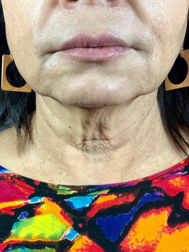 Ultherapy Before & After Gallery - Patient 142942452 - Image 1