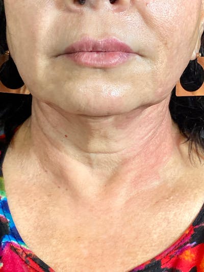 Ultherapy Before & After Gallery - Patient 142942452 - Image 2