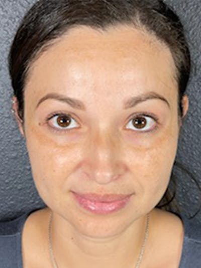 Microneedling Before & After Gallery - Patient 146380209 - Image 1