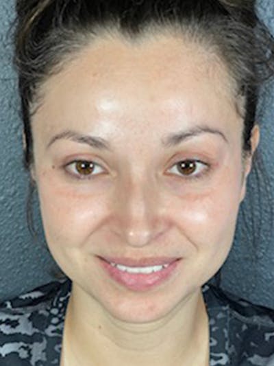 Microneedling Before & After Gallery - Patient 146380209 - Image 2