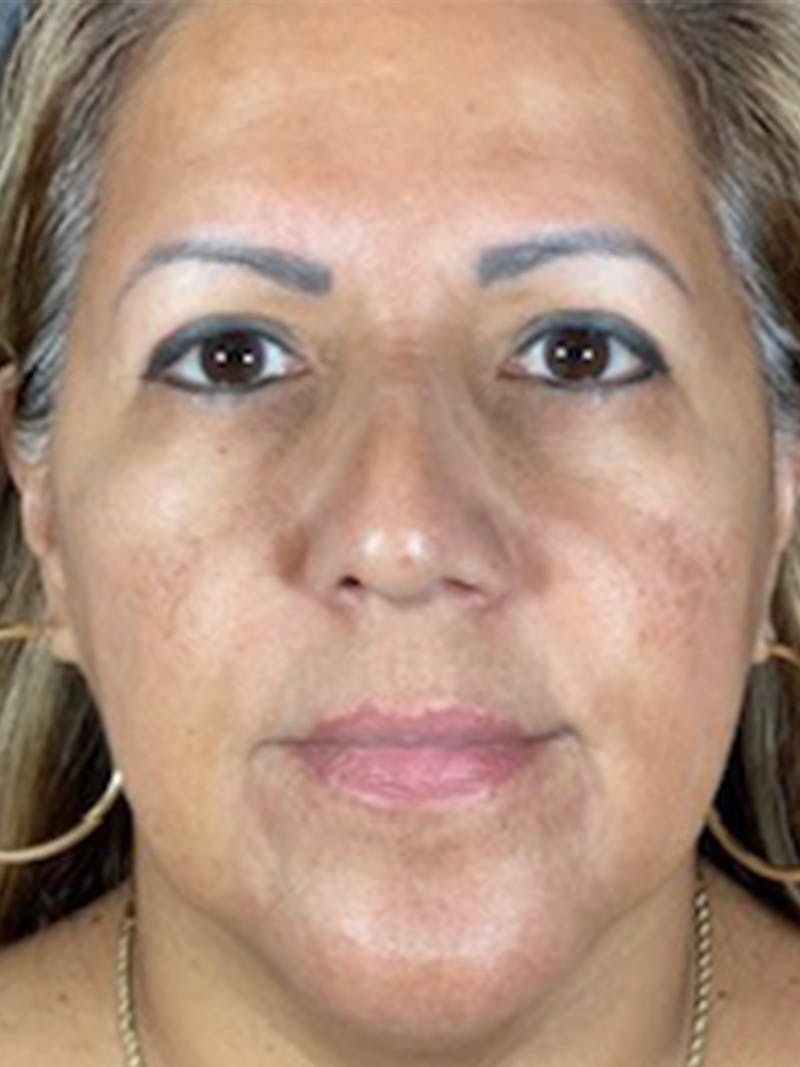 Microneedling Before & After Gallery - Patient 146380208 - Image 1