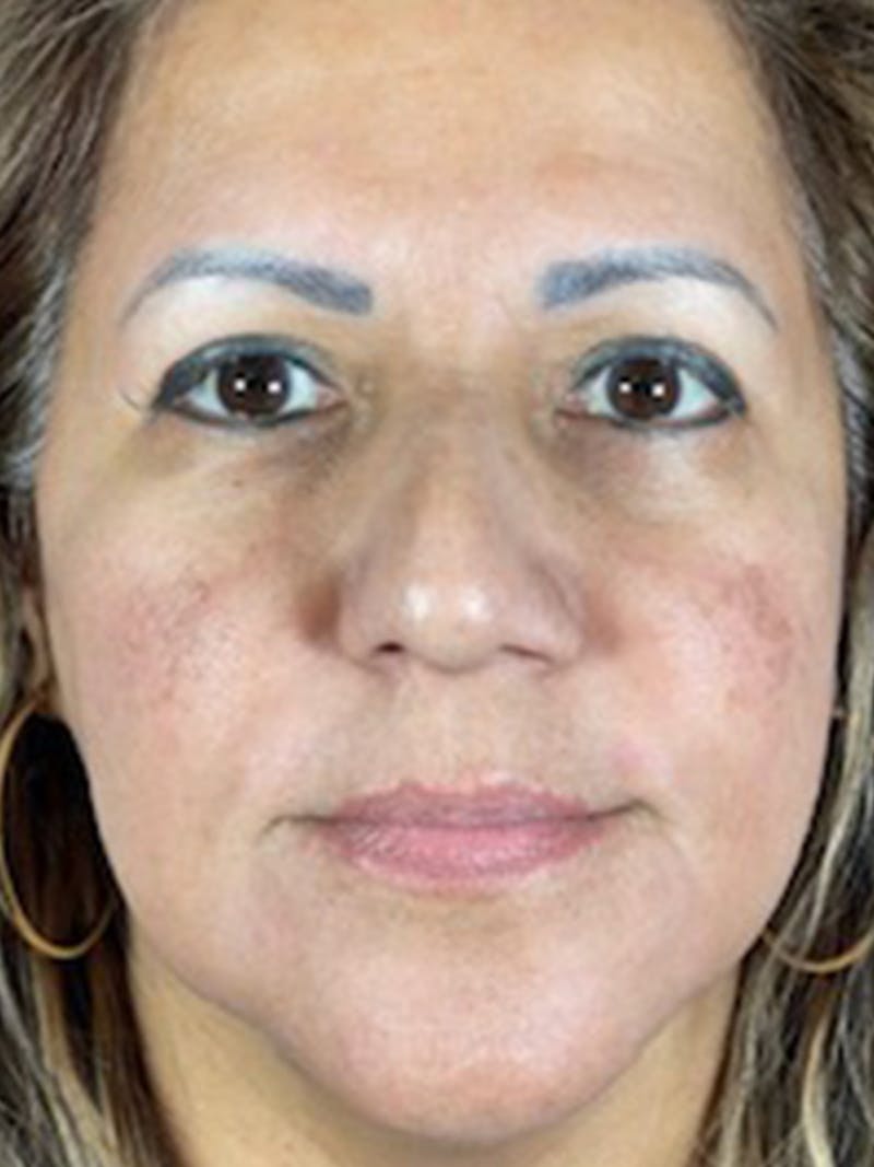 Microneedling Before & After Gallery - Patient 146380208 - Image 2
