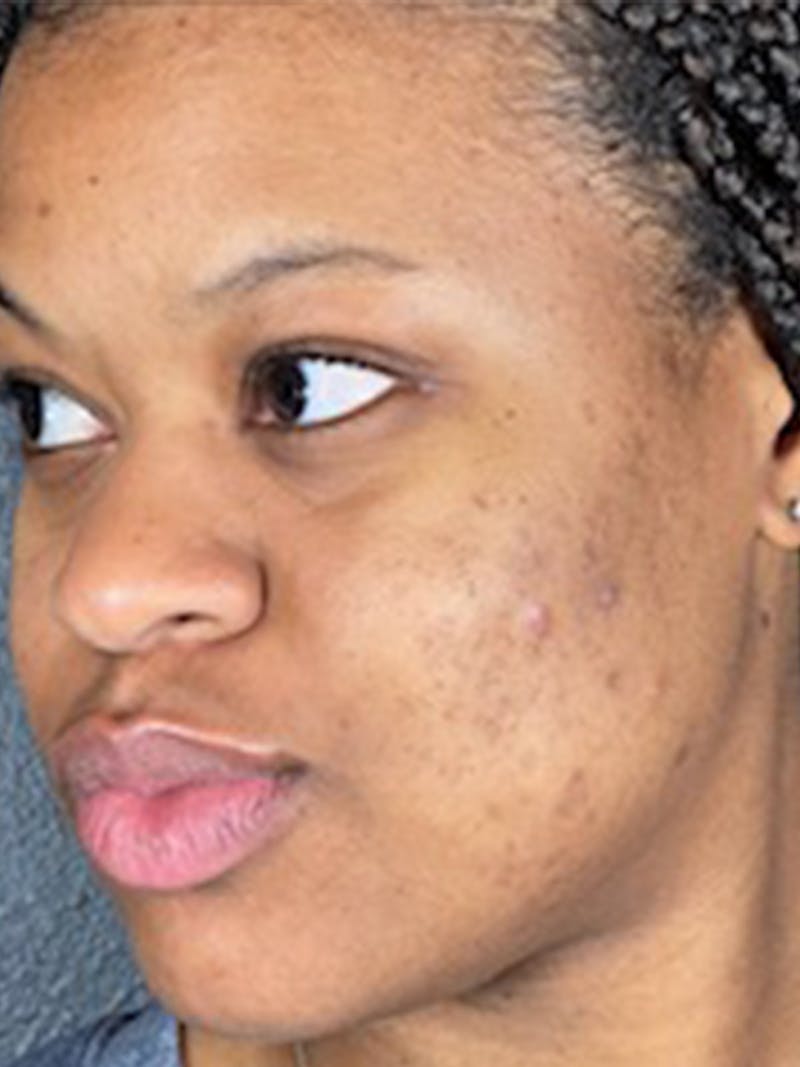 Microneedling Before & After Gallery - Patient 146380207 - Image 1
