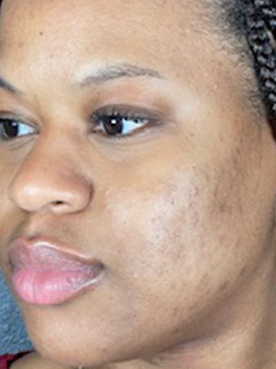 Microneedling Before & After Gallery - Patient 146380207 - Image 2
