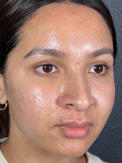 Microneedling Before & After Gallery - Patient 146380206 - Image 1