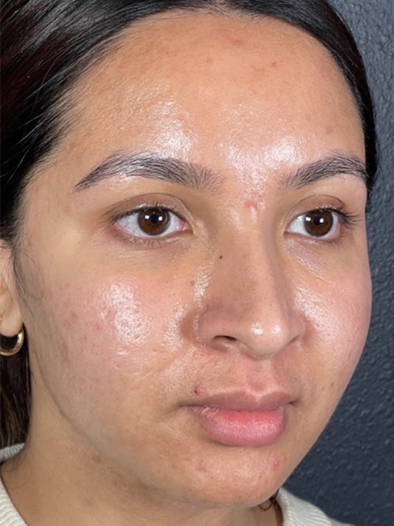 Microneedling Before & After Gallery - Patient 146380206 - Image 1