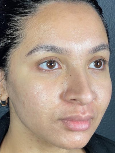 Microneedling Before & After Gallery - Patient 146380206 - Image 2