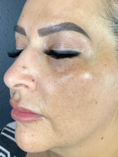 Microneedling Before & After Gallery - Patient 146380205 - Image 1