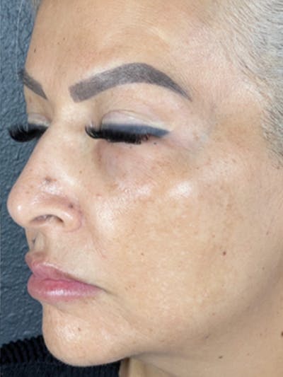 Microneedling Before & After Gallery - Patient 146380205 - Image 2