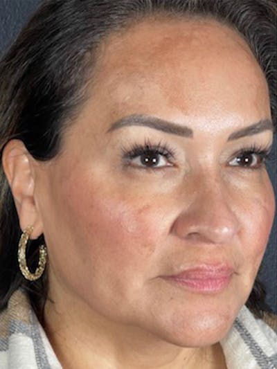 Microneedling Before & After Gallery - Patient 146380204 - Image 1