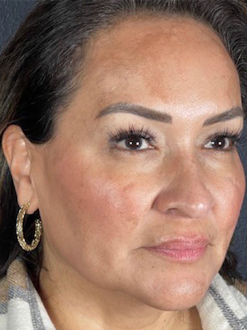 Microneedling Before & After Gallery - Patient 146380204 - Image 1