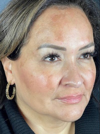Microneedling Before & After Gallery - Patient 146380204 - Image 2