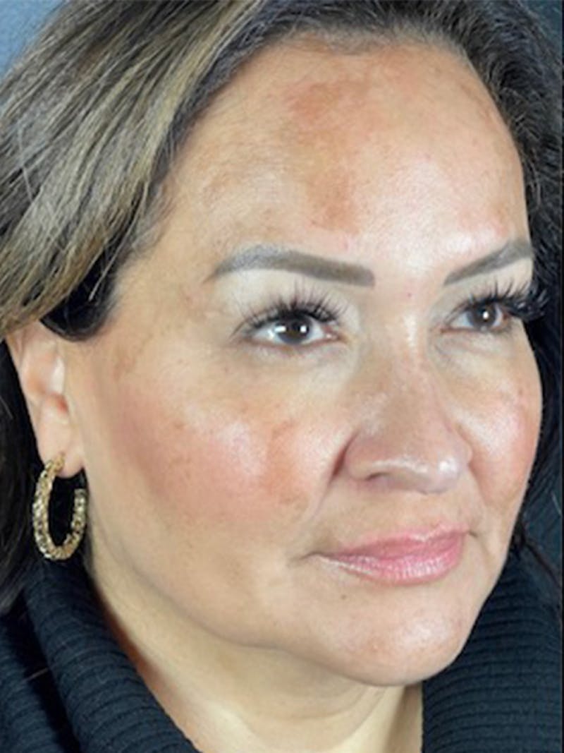 Microneedling Before & After Gallery - Patient 146380204 - Image 2