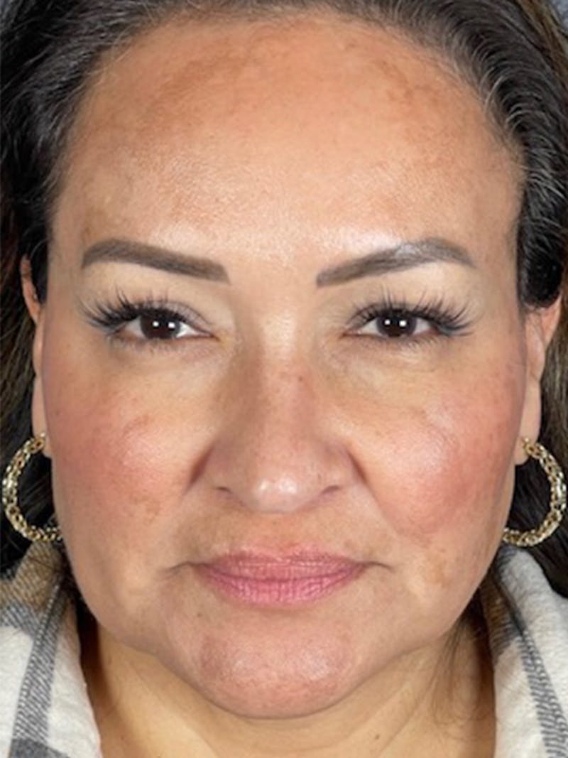 Microneedling Before & After Gallery - Patient 146380204 - Image 3