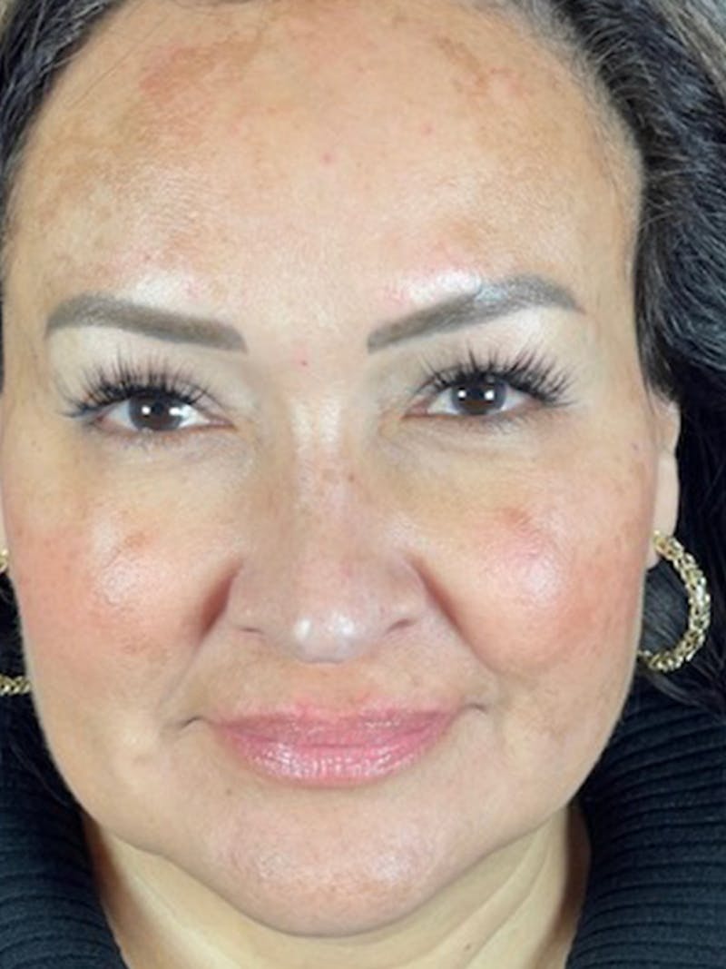 Microneedling Before & After Gallery - Patient 146380204 - Image 4