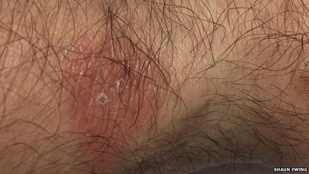 Dragers van Fitbit-polsband krijgen last van uitslag