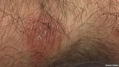 Dragers van Fitbit-polsband krijgen last van uitslag