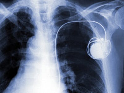 ‘Hacker kan pacemaker-drager draadloos doden’