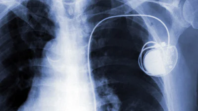‘Hacker kan pacemaker-drager draadloos doden’