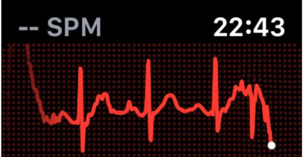 Hoe goed kan de Apple Watch 4 hartfilmpjes (ECG's) maken?