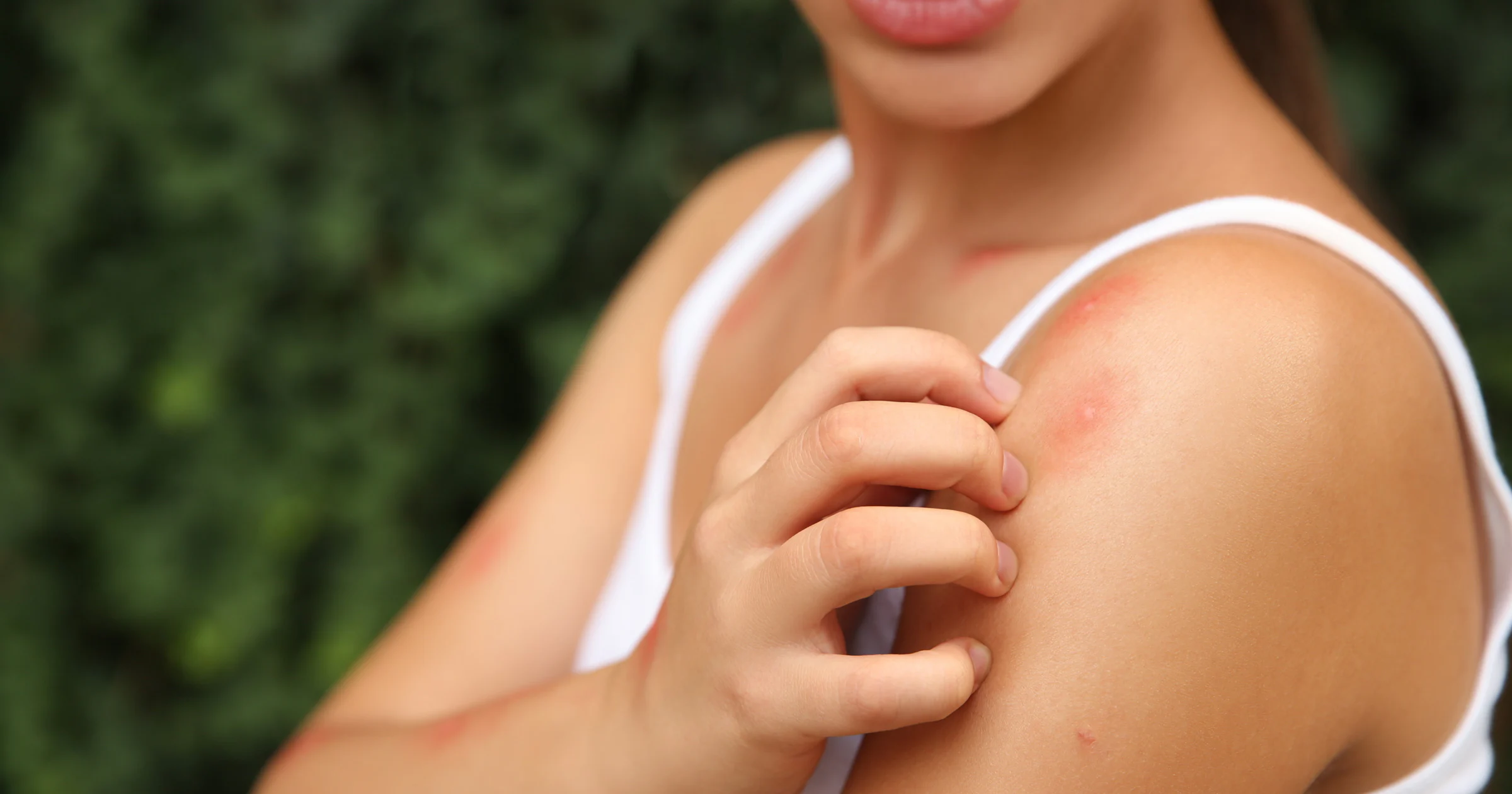 Beestjeszomer: dit kun je doen tegen insectenbeten