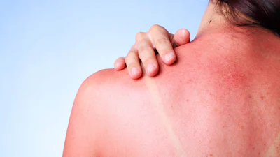 Help! Eerste hulp bij verbranding door de zon