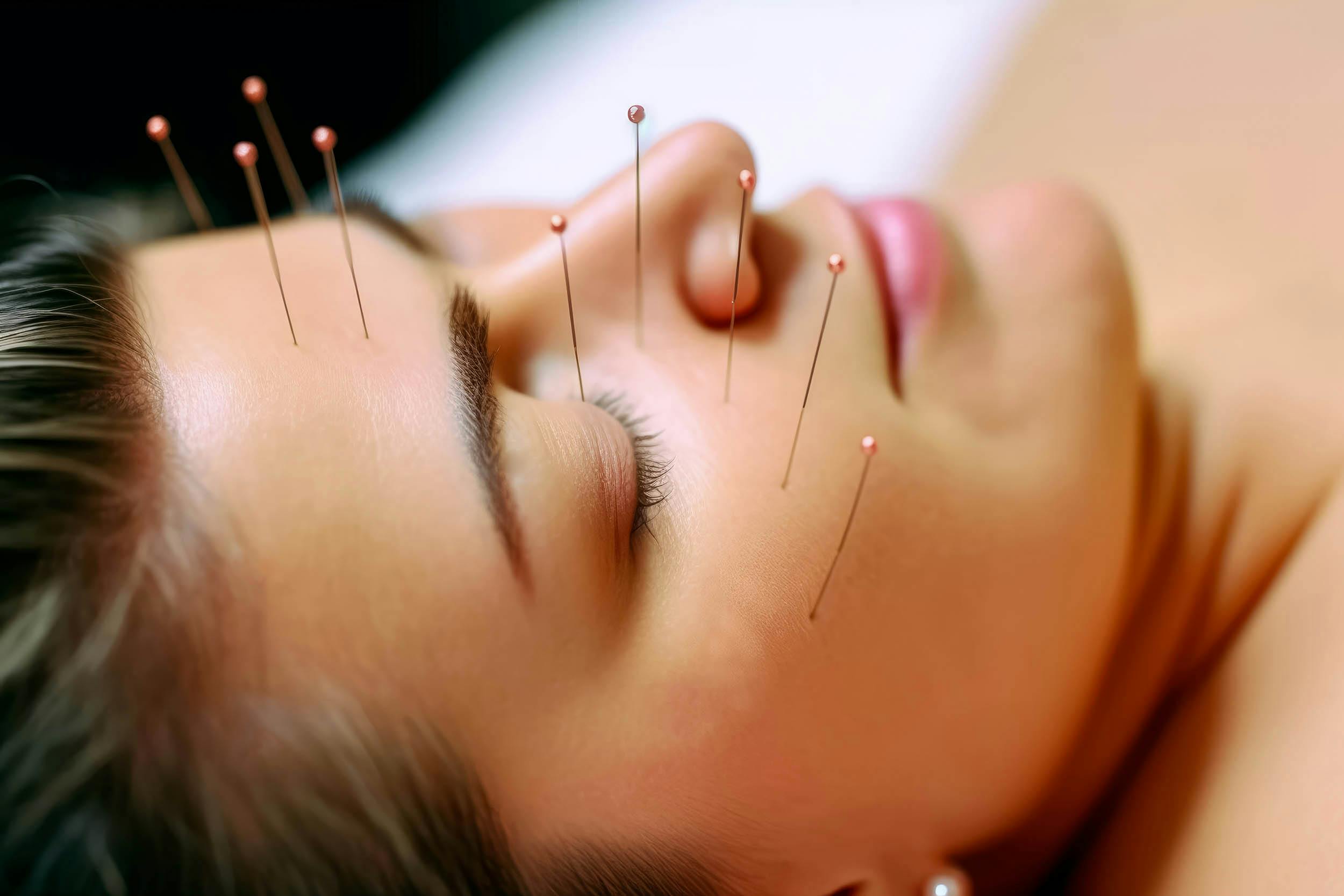 Acupunctuur