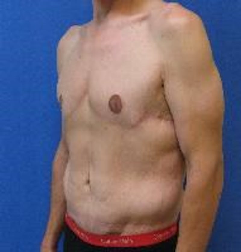 Dr. Cayce Rumsey Before & After Gallery - Patient 89393307 - Image 6
