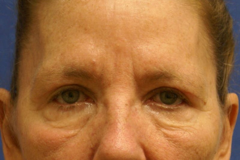 Dr. Cayce Rumsey Before & After Gallery - Patient 89410417 - Image 2