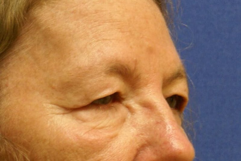 Dr. Cayce Rumsey Before & After Gallery - Patient 89410417 - Image 3