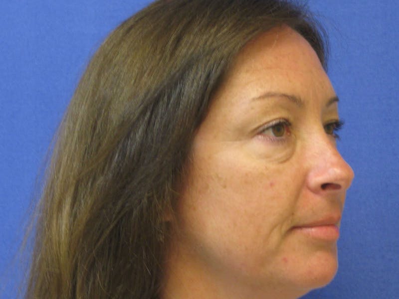 Dr. Cayce Rumsey Before & After Gallery - Patient 89410437 - Image 3
