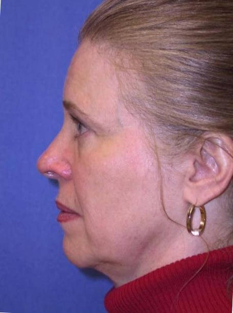 Dr. Cayce Rumsey Before & After Gallery - Patient 89410468 - Image 3