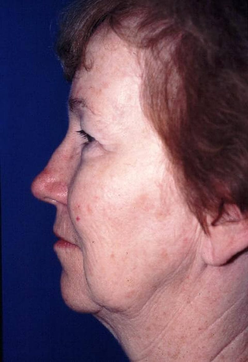 Dr. Cayce Rumsey Before & After Gallery - Patient 89410482 - Image 3
