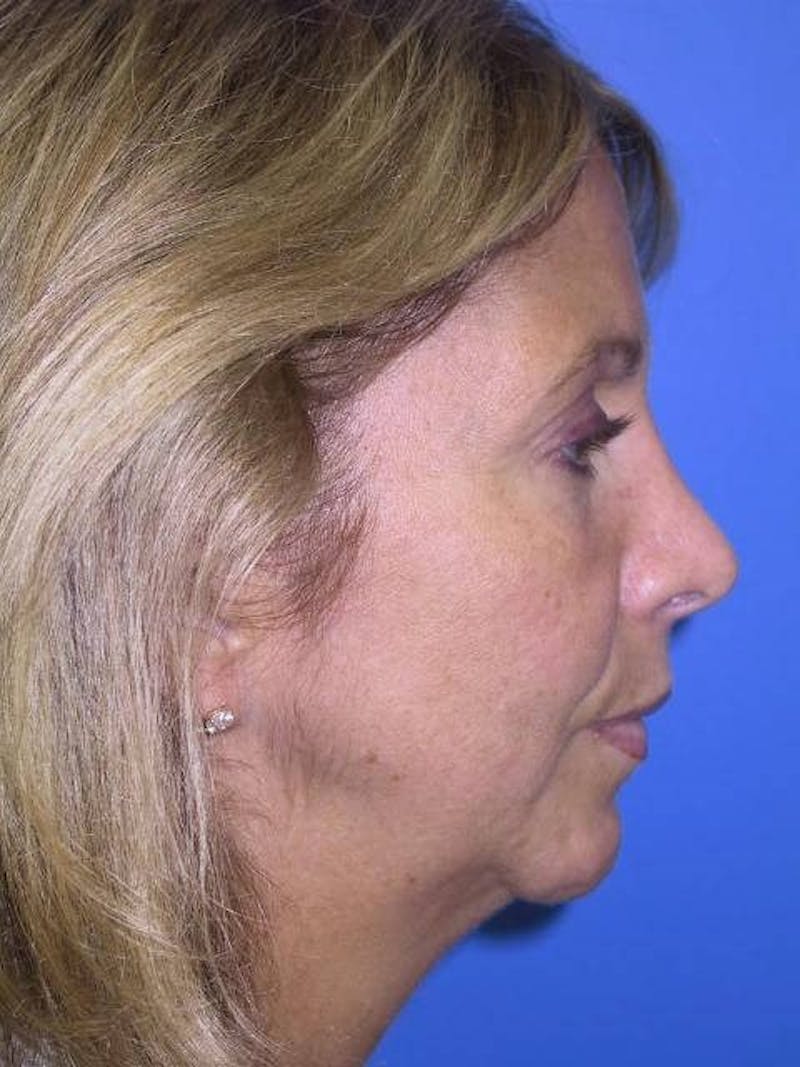 Dr. Cayce Rumsey Before & After Gallery - Patient 89410483 - Image 3
