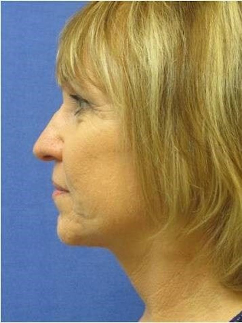 Dr. Cayce Rumsey Before & After Gallery - Patient 89410485 - Image 2