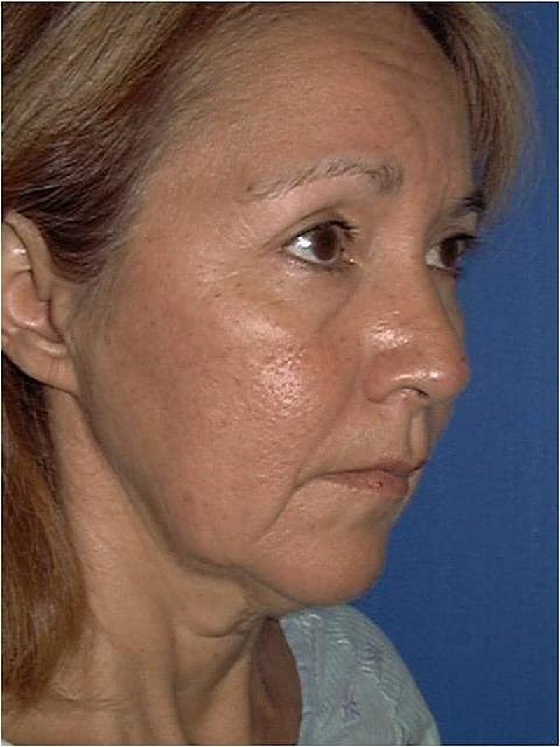 Dr. Cayce Rumsey Before & After Gallery - Patient 89853263 - Image 1