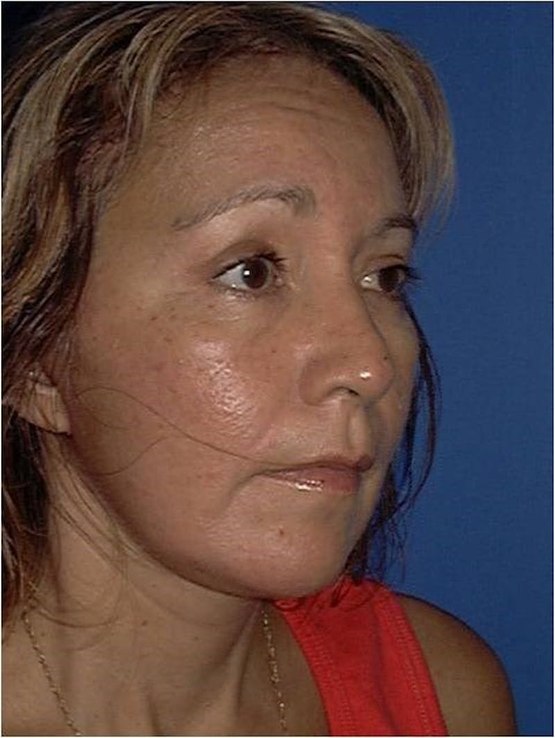 Dr. Cayce Rumsey Before & After Gallery - Patient 89853263 - Image 2