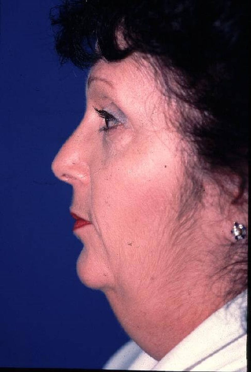 Dr. Cayce Rumsey Before & After Gallery - Patient 89853309 - Image 3