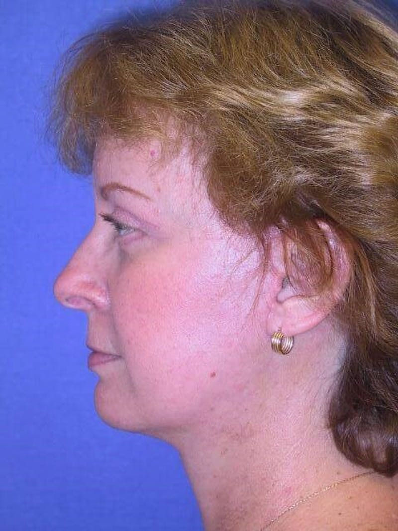 Dr. Cayce Rumsey Before & After Gallery - Patient 89853468 - Image 2