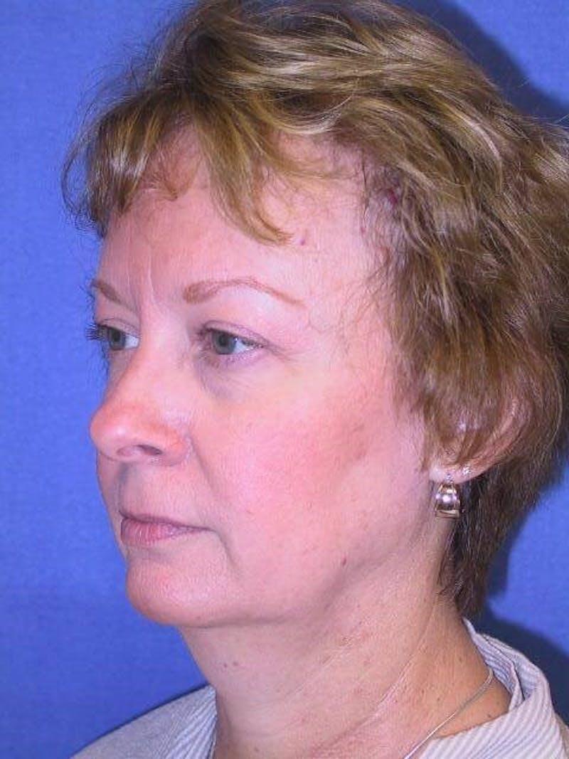 Dr. Cayce Rumsey Before & After Gallery - Patient 89853468 - Image 3