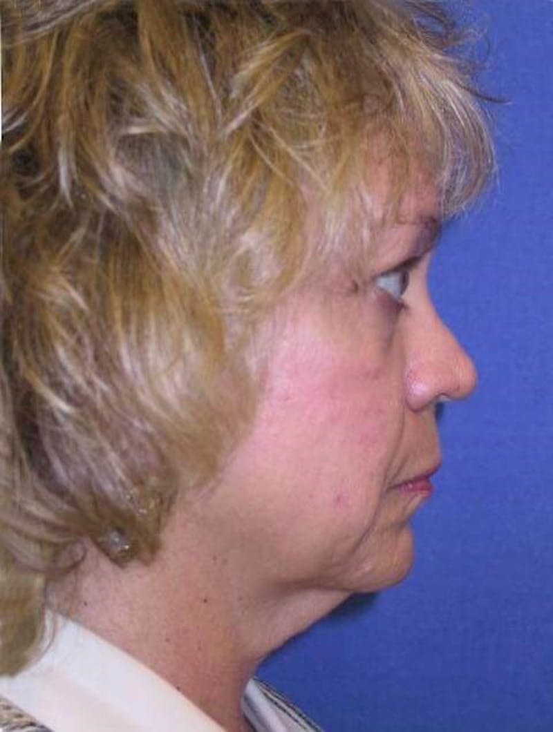 Dr. Cayce Rumsey Before & After Gallery - Patient 89859375 - Image 5