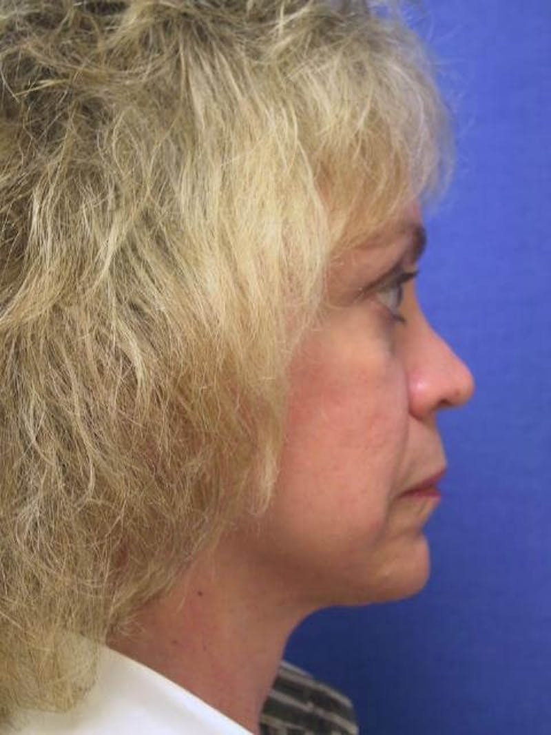 Dr. Cayce Rumsey Before & After Gallery - Patient 89859375 - Image 6