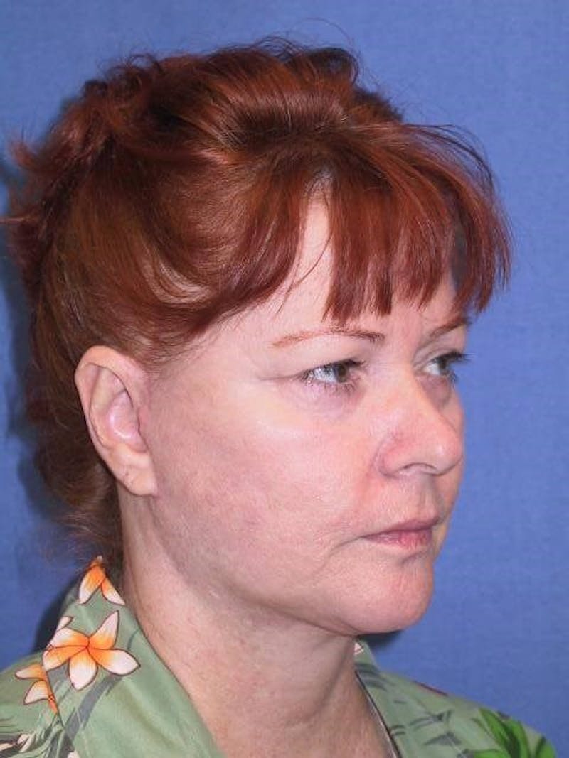 Dr. Cayce Rumsey Before & After Gallery - Patient 89859427 - Image 2
