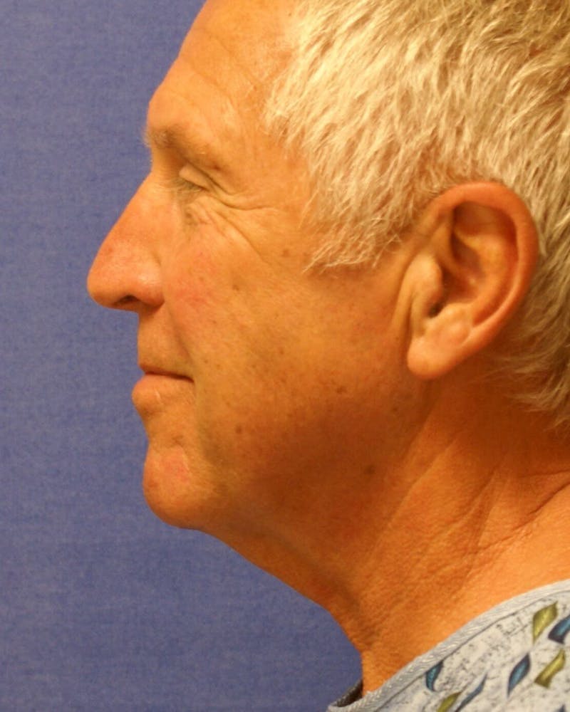 Dr. Cayce Rumsey Before & After Gallery - Patient 89860616 - Image 3